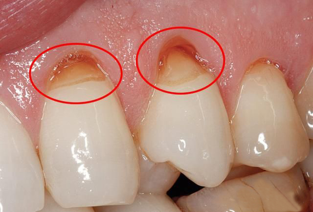 怎样把黄牙刷白,怎样快速把黄牙刷白