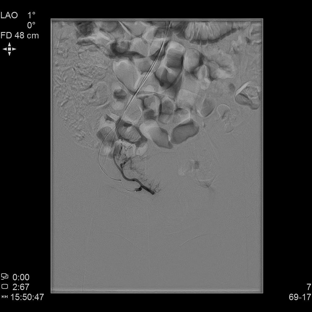 「不死的癌症」之克星——子宫腺肌症介入栓塞治疗