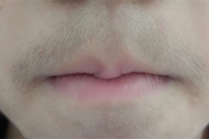 10岁女孩胡须明显怎么处理,10岁女孩长胡子不能吃什么