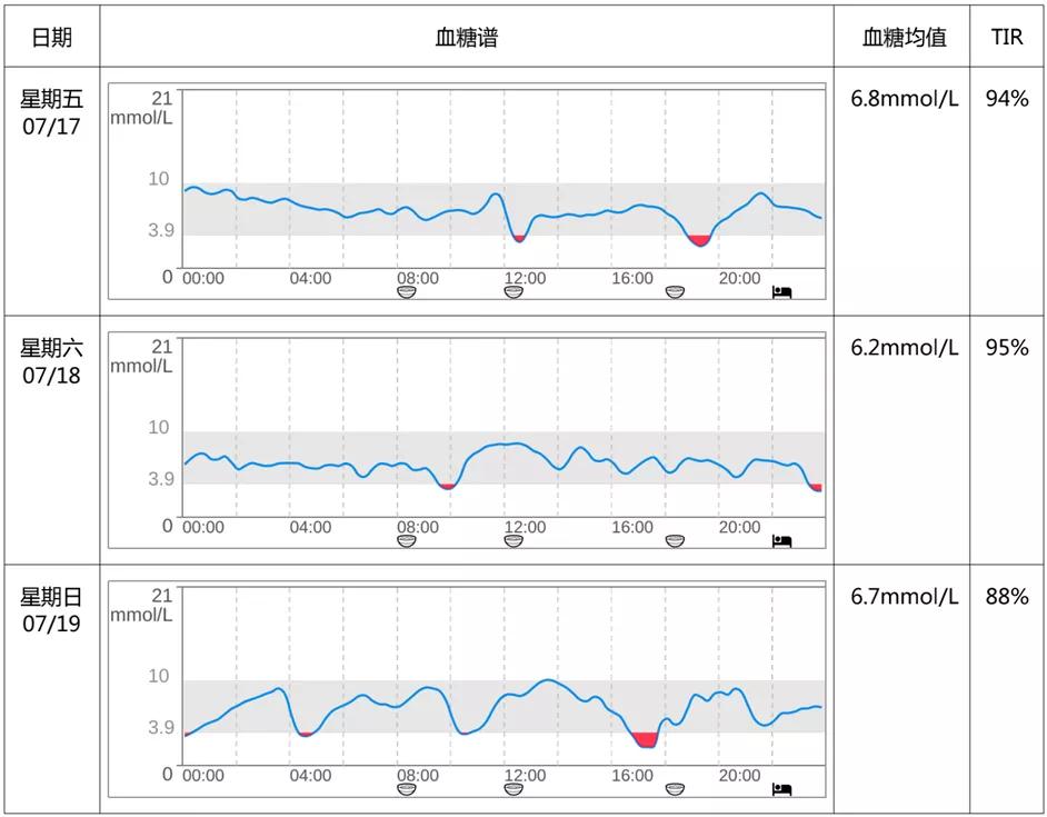 反复低血糖是肿瘤吗,读报反复低血糖警惕胰岛素瘤
