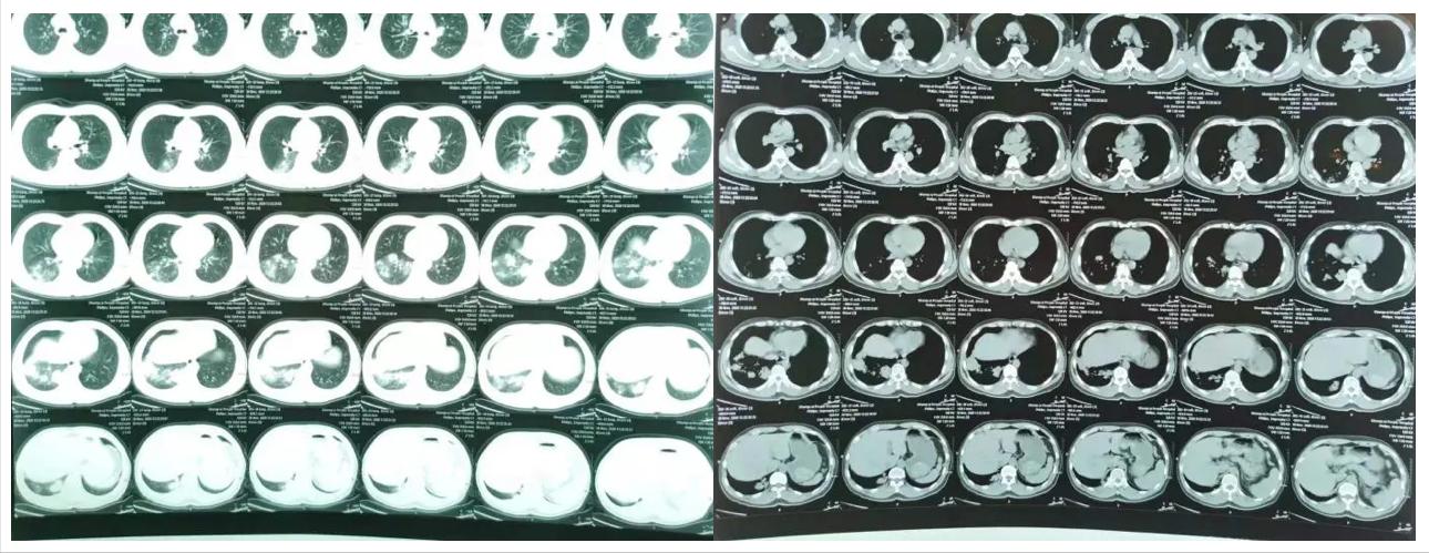 肺炎不干预治疗一般多久可以痊愈,肺炎治疗20天不见好转