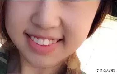 花了18000的牙齿矫正划不划算,牙齿矫正8000重庆