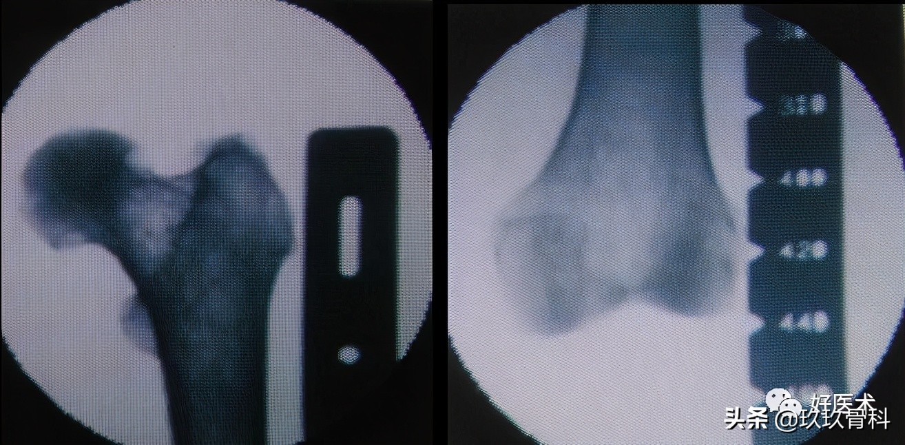 髓内钉技巧,髓内钉教学视频讲解