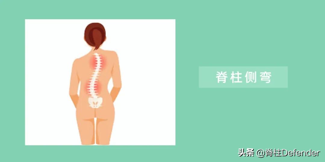 高低肩怎么健身矫正,驼背高低肩怎么矫正