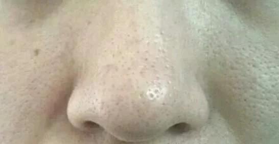 女人脸上皮肤粗糙毛孔粗大怎么办,皮肤粗糙暗沉毛孔粗大怎么改善男