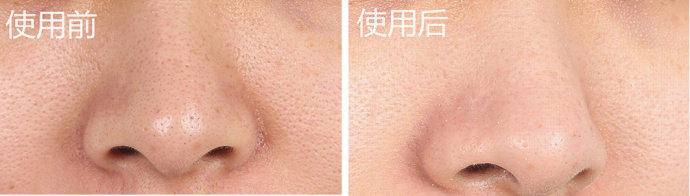 去黑头攻略：被黑头耽误的鼻子是该处理一下了