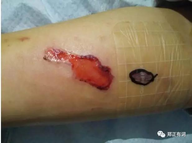 静脉输液港植入是治疗什么病的,静脉输液港植入术