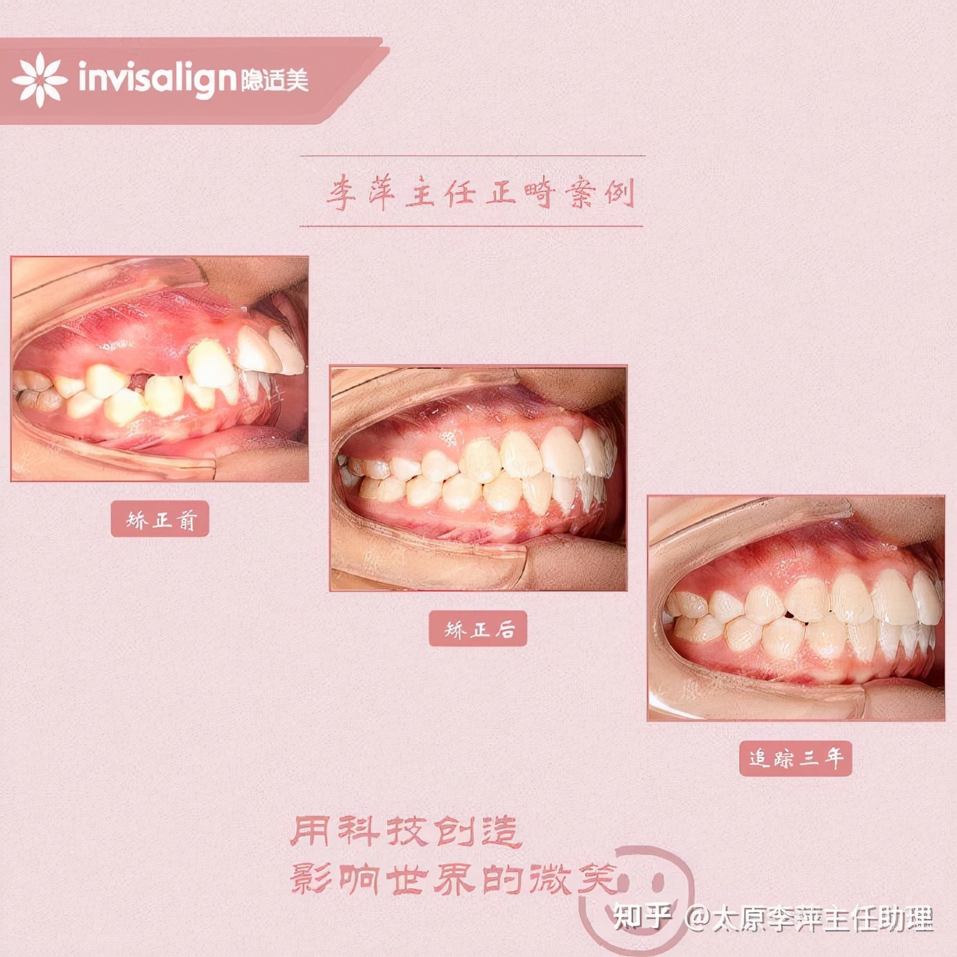 太原市牙齿正畸,太原市口腔正畸
