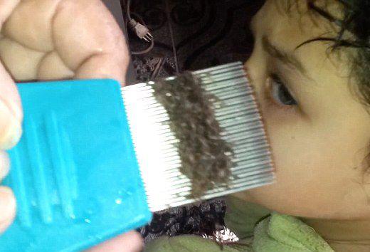 头上有虱子卵的虱子怎么彻底清除,头上长虱子怎么彻底去除更方便