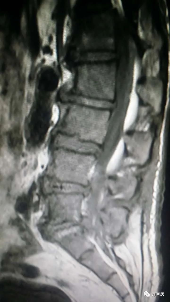 腰椎手术切掉棘突,腰突微创后出血肿