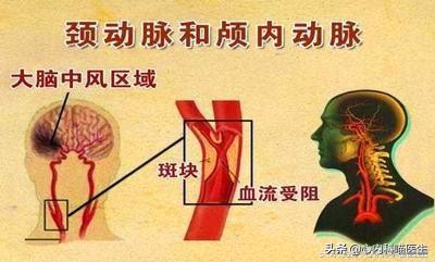 颈部动脉增厚怎么回事,颈部动脉有斑块会引起哪些危害