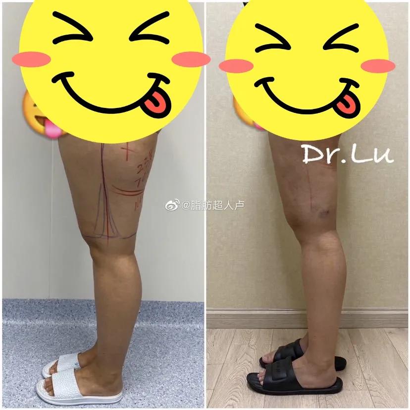 吸脂和溶脂针选哪个,怎么看是需要打瘦腿针还是吸脂