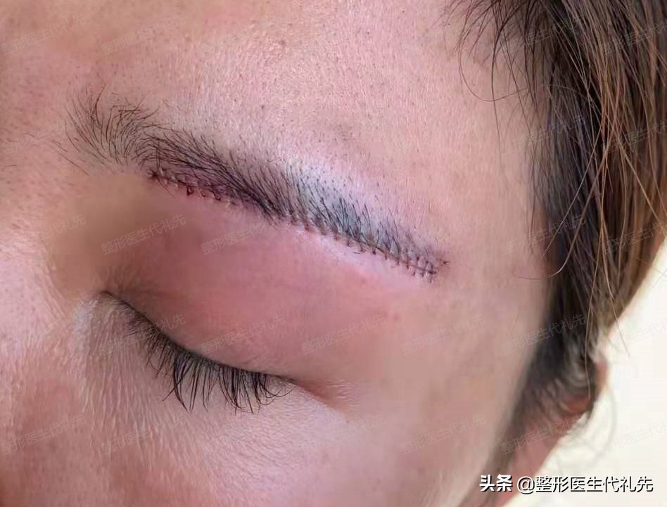 提眉手术的说法,提眉整形问答