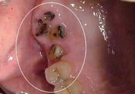 不能拔牙怎么去除坏牙,是不是什么牙都可以拔掉