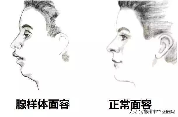 腺样体肥大看中医还是耳鼻喉科好,治疗腺样体肥大中医好还是西医好