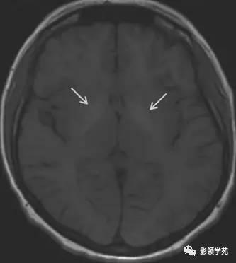 头部t1wi信号不均匀增高,脑t1wi和t2wi稍低信号