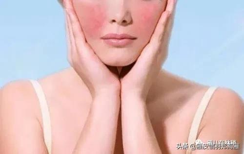 玫瑰痤疮酒糟鼻涂抹什么药,玫瑰痤疮别名酒糟鼻怎么治疗