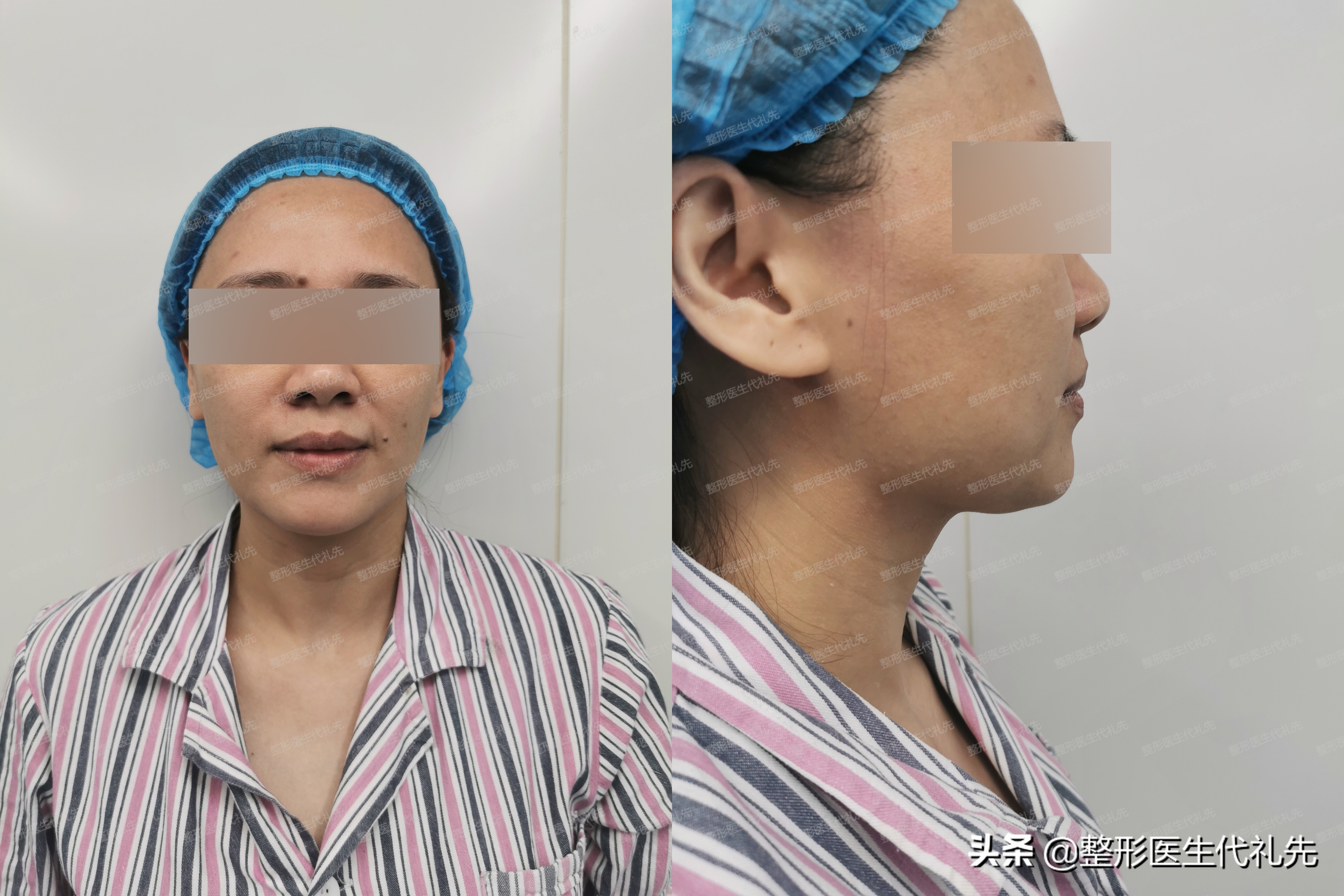 脸下垂松弛真能做面部提升有用吗,面部轮廓松弛下垂怎么改善