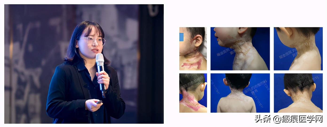 鐦㈢棔妗堜緥,鐤ょ棔娌荤枟鎴愬姛妗堜緥