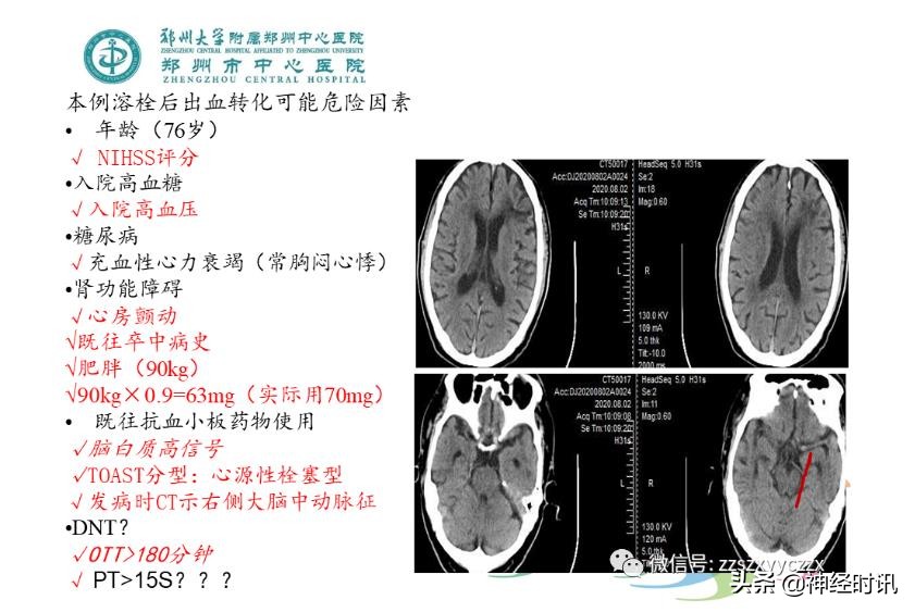 静脉溶栓怎么引起的,静脉相关并发症的预防及处理