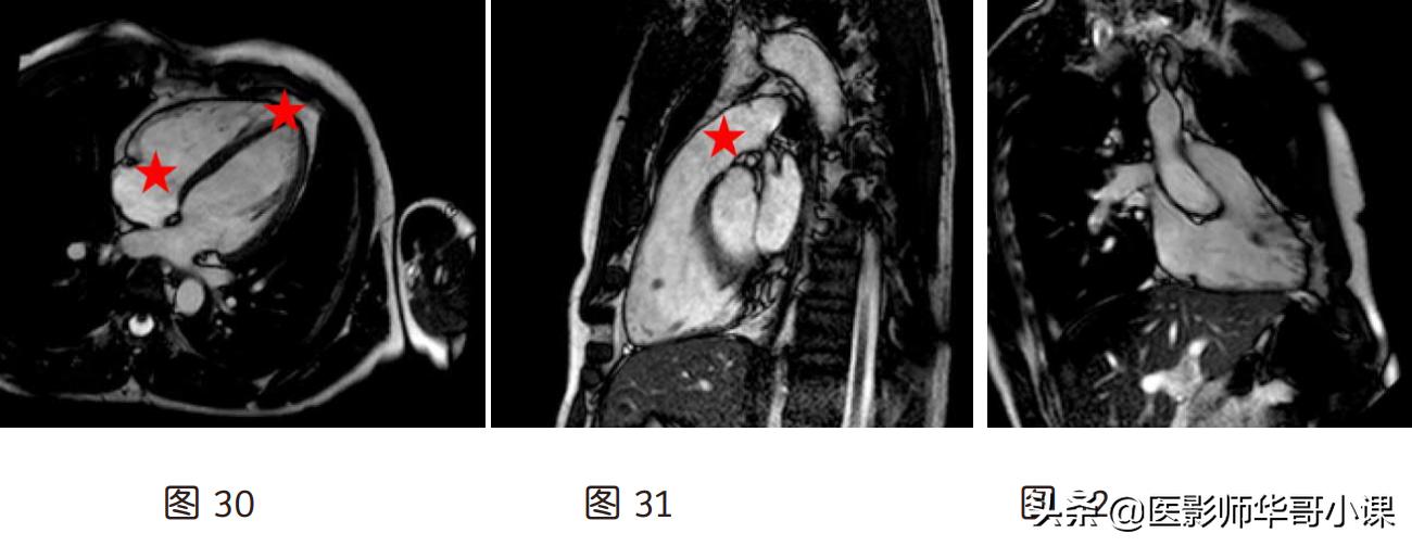 心脏mr增强扫描讲解,磁共振心脏扫描标准切面