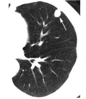 曾经有一个机会但是没有珍惜,子宫肉瘤做子宫全切术