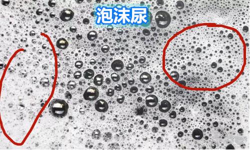 尿尿起沫肾不好吗,尿蛋白高尿尿起泡沫吗