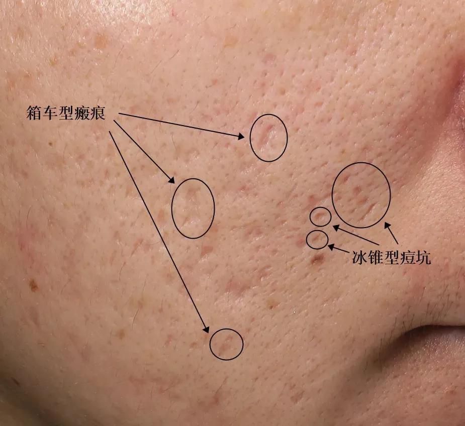 很多小痘坑修复好能和以前一样吗,顽固黑头痘坑