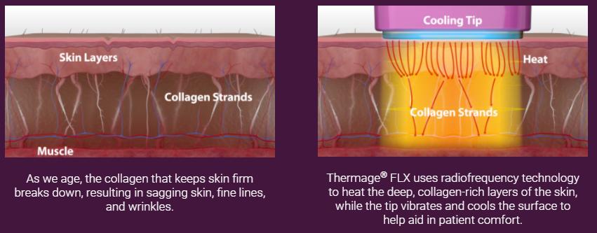 几万块的热玛吉真的值得做吗,上万块一次的热玛吉