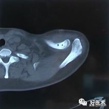 治疗肩锁关节脱位，有最好的方法吗？