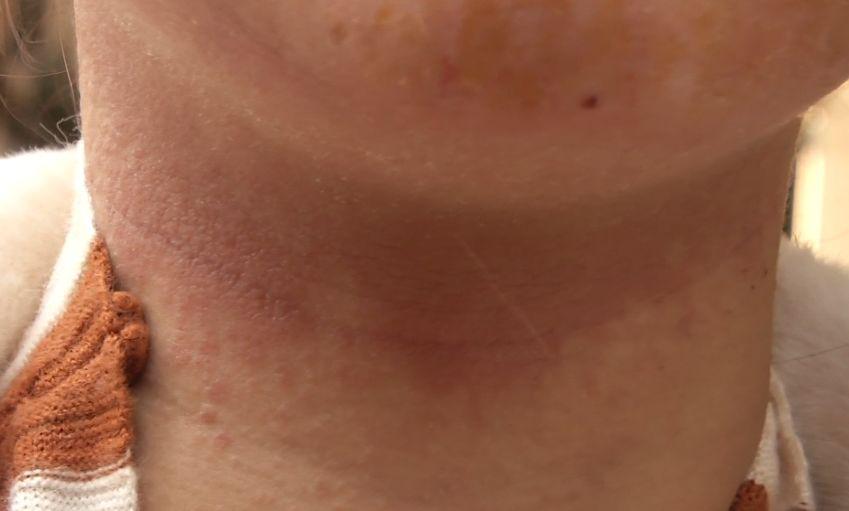 美容院回来脸上红肿痒怎么办,过敏脸部红肿痒美容院