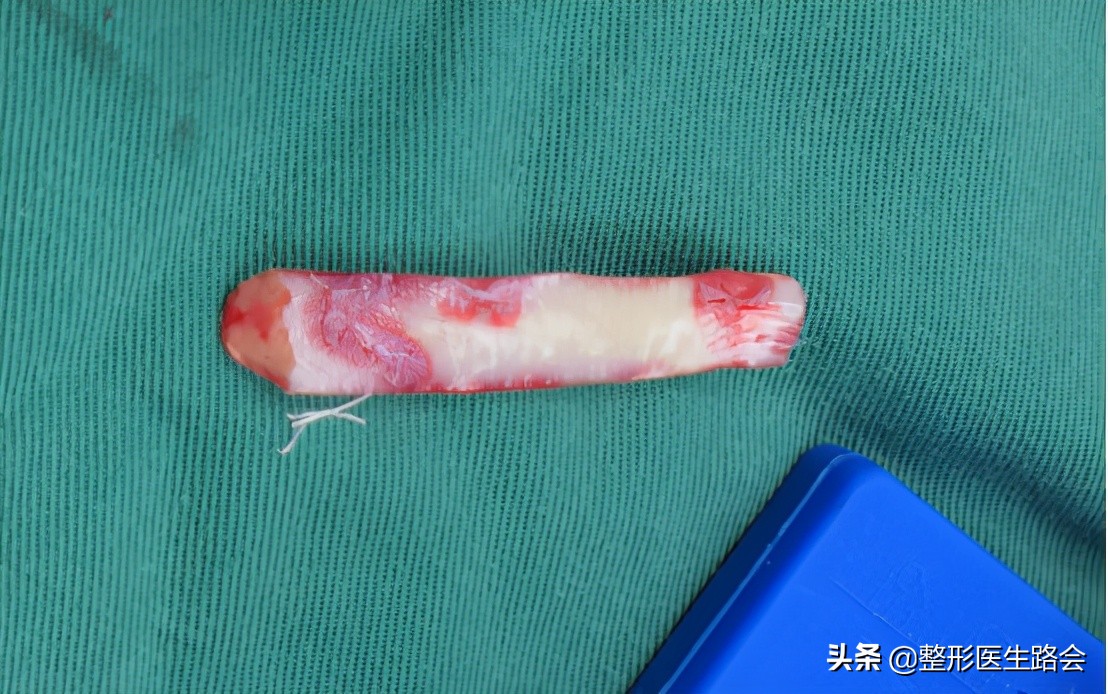 做的耳软骨鼻塌下去了怎么修复啊,做了耳软骨鼻如何不塌