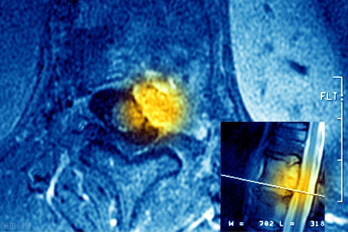 多发性神经鞘瘤中医能治疗么,多发性神经鞘瘤属于基因突变吗