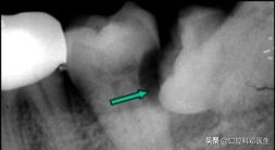 不要让牙齿毁了你的五官,别让一颗牙毁一口牙