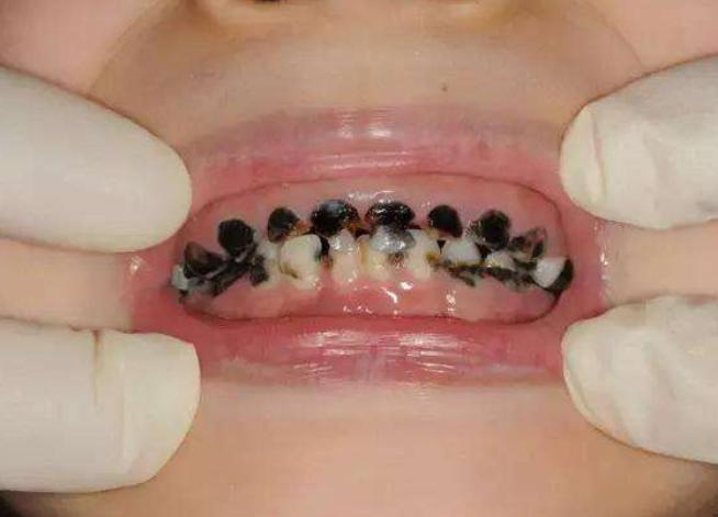 小孩牙齿过稀怎么办,小孩牙齿磨损不能吃什么