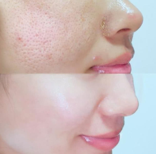 鼻子挤出一个洞怎么处理,鼻子挤出黄粒留下一个洞怎么处理