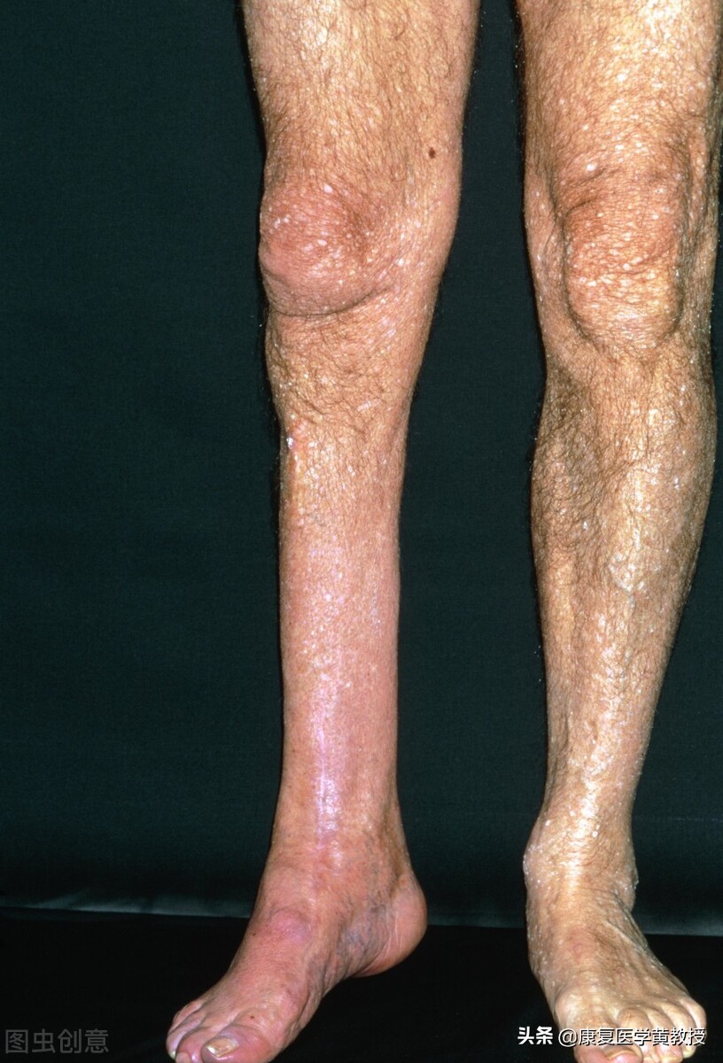 骨折肌肉萎缩最佳恢复方法,骨折后鸡肌萎缩是什么症状