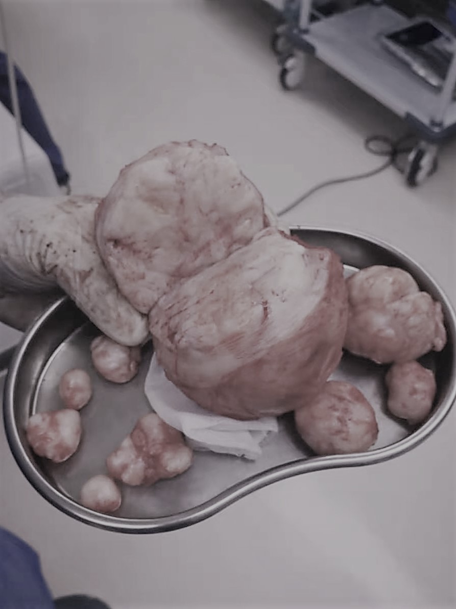 子宫肌瘤切除子宫伤痕累累,多发性肌瘤在什么情况下要手术