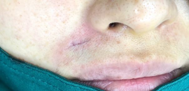 黑色素痣用激光还是手术,痣是手术切除好还是激光好