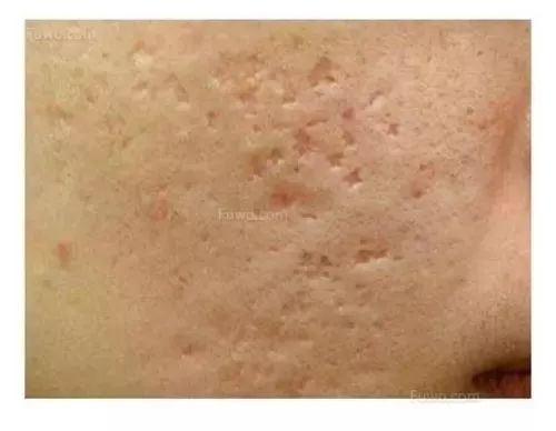 祛痘印小方法和步骤有哪些,痘印肌肤的护肤方法