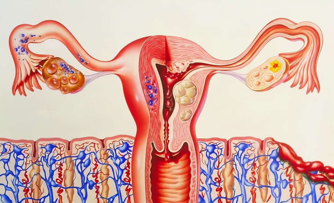 中医治疗多囊卵巢综合症效果好吗,舒氏针灸一般能治好多囊卵巢吗