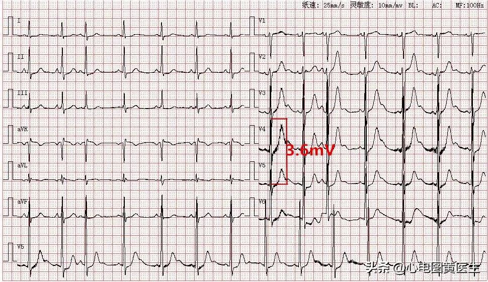 心电图出现qrs电压交替现象,心电图出现u和t波倒置