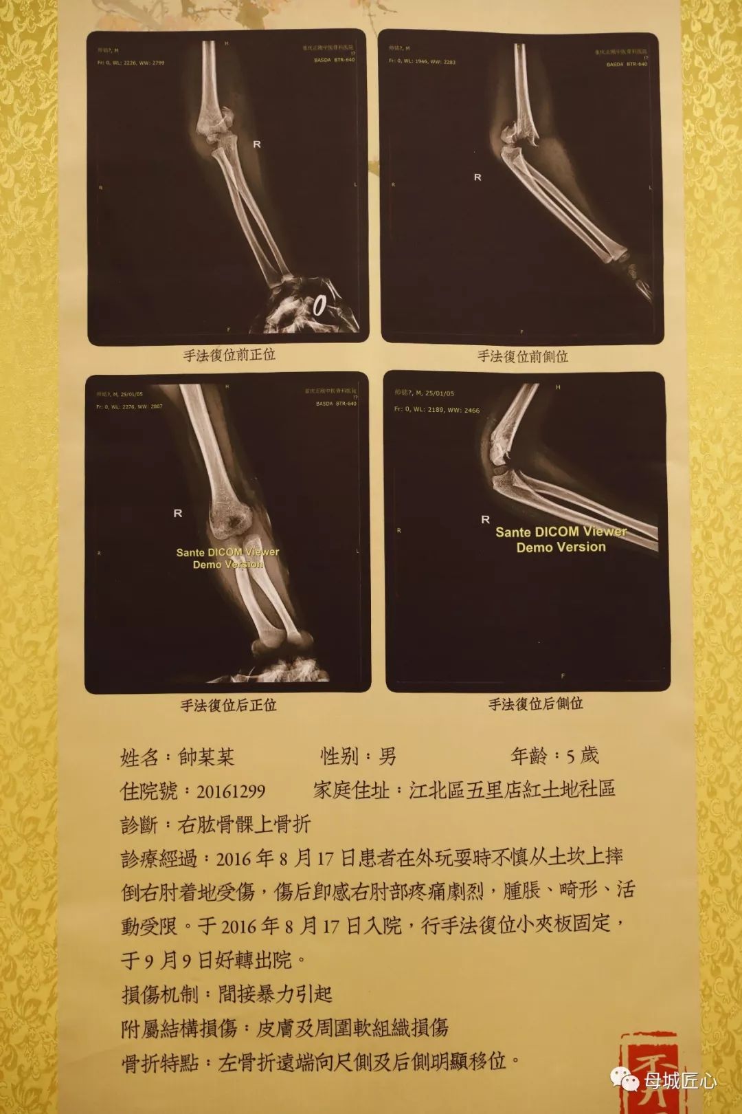 老中医不开刀治骨折,不开刀治疗癌症中医