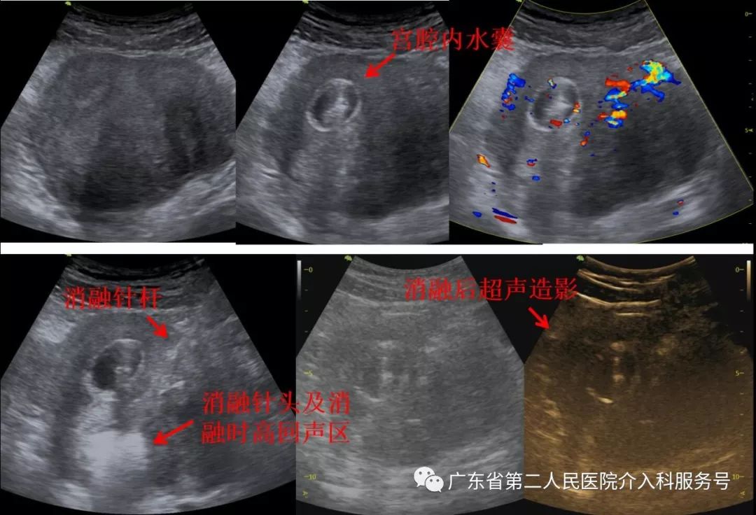 经皮穿刺肿瘤物理消融术,介入治疗痛经