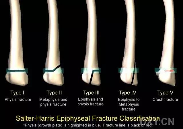 所有骨折都叫什么名字,骨折的名称有哪些