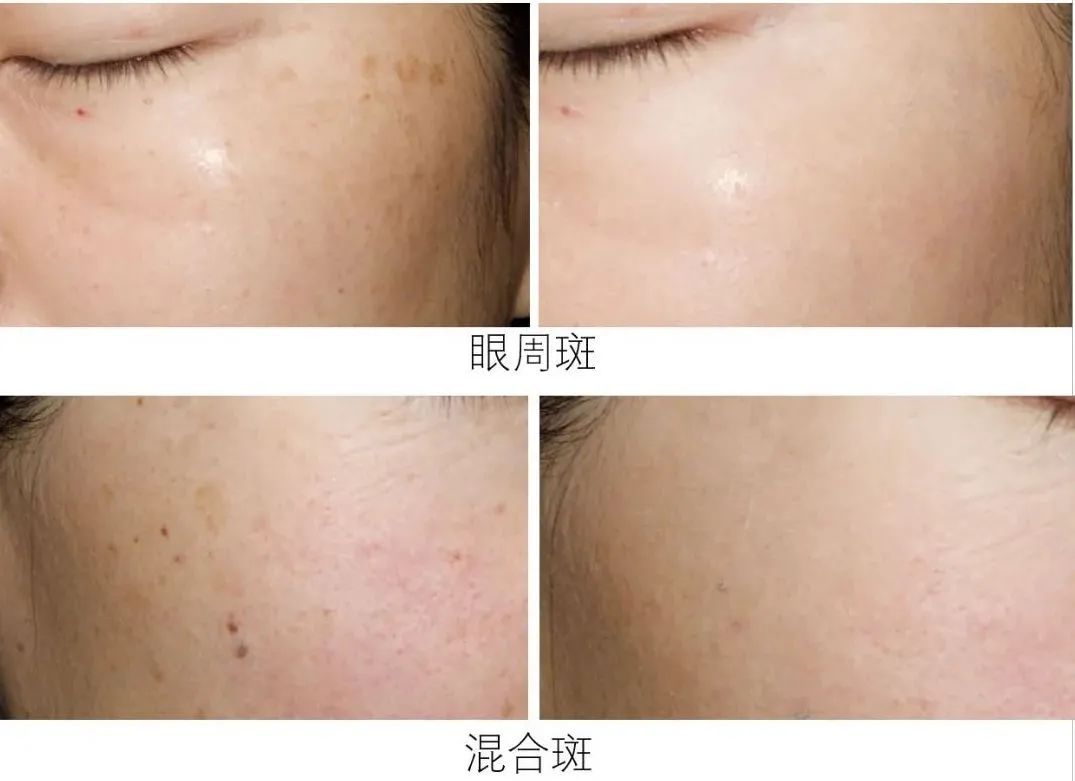 目前为止最温和无伤害的祛斑方法,揭秘有效祛斑方法大爆料