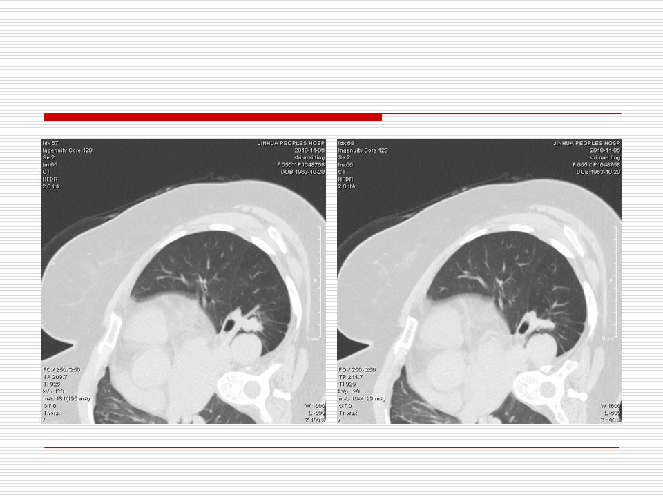 像炎症的肺癌能治好吗,医生说可能是肺癌也可能是炎症
