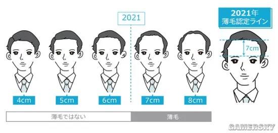 所以秃头的标准是发际线高≥7cm？头秃代表不再是中老年独扛大旗，90后、00后也在积极踊跃加入组织