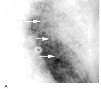 肺实变和肺炎的影像学区别,肺实变图