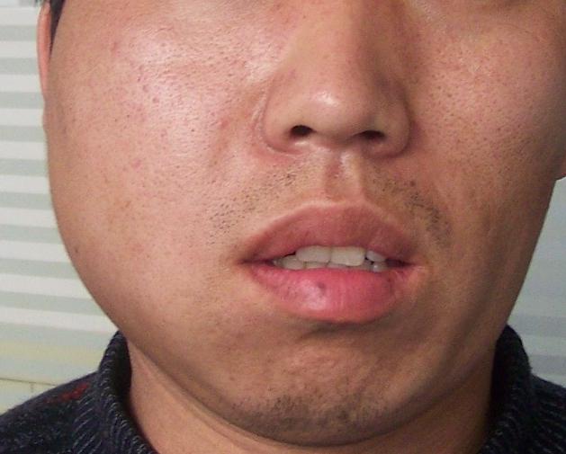 智齿蛀牙痛有什么有效方法止痛,智齿旁边牙松动蛀牙如何处理